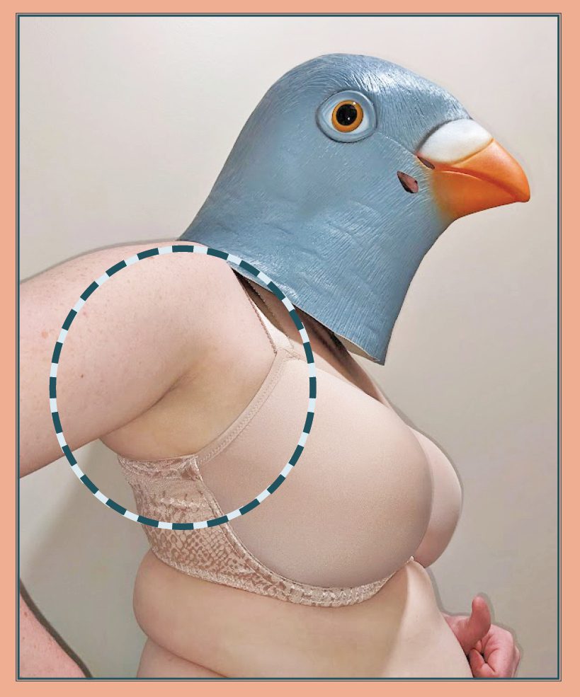 Underarm Anatomy or Bra Fit Problem?