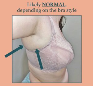 Extra skin over the bra band is probably normal