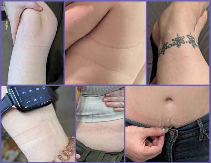 Examples of pressure marks